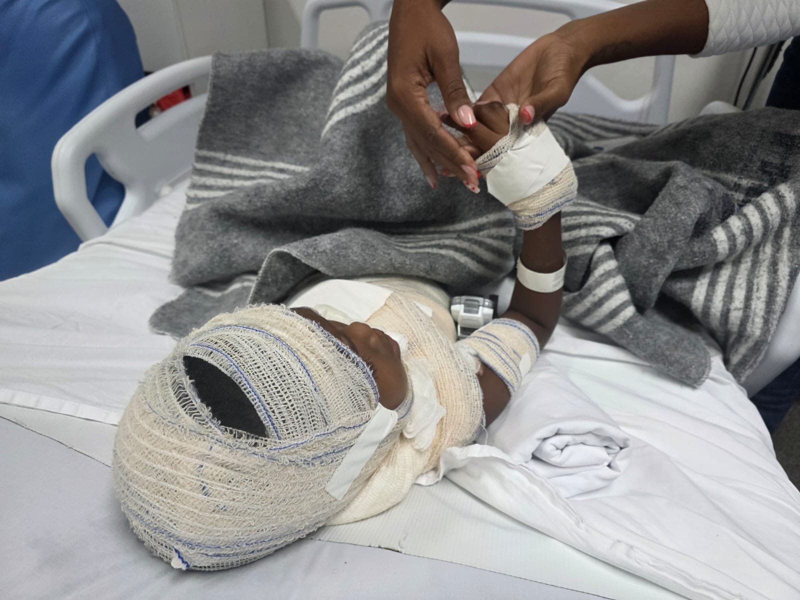 Junho Laranja: Hospitais alertam para aumento de queimados com a chegada das festas típicas